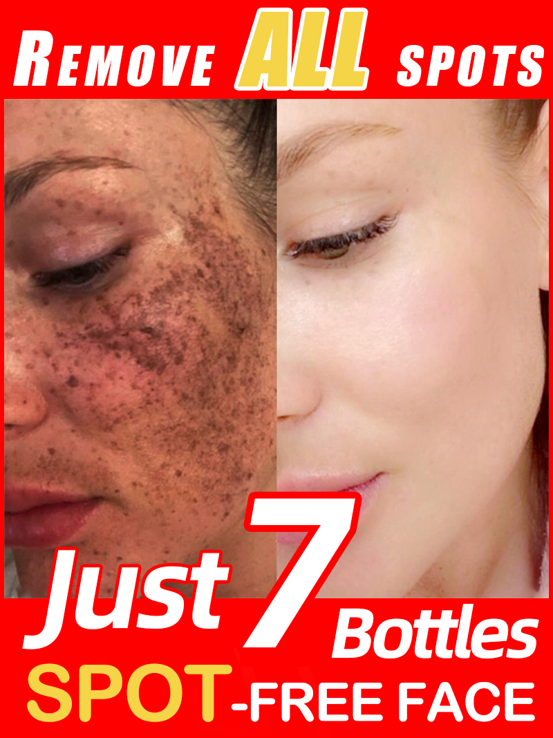 Luxury Natural Skincare - Ilumine sardas melasma, manchas escuras faciais